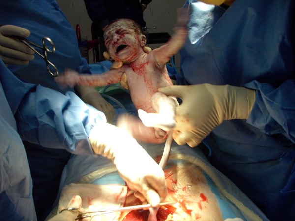 Dr Serag Youssif Caesarean Section 2